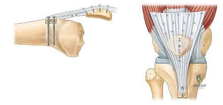 تثبيت الخيوط الجراحية في الرضفة