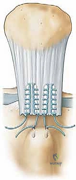 التحضير الجراحي وتحديد مكان التمزق