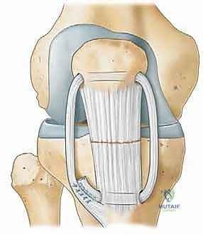 تمزق وتر الرضفة: دليل شامل للعلاج والتعافي مع الأستاذ الدكتور محمد هطيف
