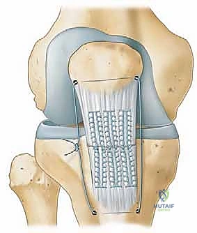 مراحل التثبيت النهائي للوتر وإغلاق الجرح