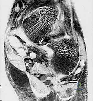 صورة توضيحية لـ إعادة بناء الرباط الزنبركي: حل شامل للقدم المسطحة المكتسبة مع الأستاذ الدكتور محمد هطيف