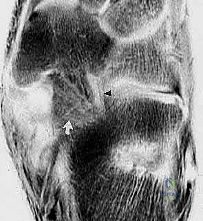 إعادة بناء الرباط الزنبركي: حل شامل للقدم المسطحة المكتسبة مع الأستاذ الدكتور محمد هطيف