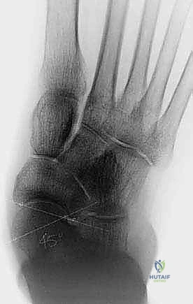 صورة توضيحية لـ إعادة بناء الرباط الزنبركي: حل شامل للقدم المسطحة المكتسبة مع الأستاذ الدكتور محمد هطيف