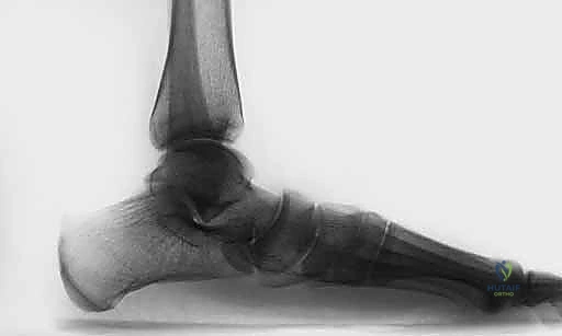 صورة توضيحية لـ إعادة بناء الرباط الزنبركي: حل شامل للقدم المسطحة المكتسبة مع الأستاذ الدكتور محمد هطيف