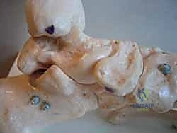 توضيح لانهيار القوس الطولي والميكانيكا الحيوية للقدم