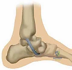 صورة توضيحية لـ إعادة بناء الرباط الزنبركي: حل شامل للقدم المسطحة المكتسبة مع الأستاذ الدكتور محمد هطيف
