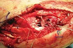 صورة توضيحية لـ إعادة بناء الرباط الزنبركي: حل شامل للقدم المسطحة المكتسبة مع الأستاذ الدكتور محمد هطيف