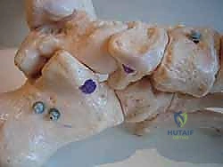 الفحص السريري الدقيق لمريض القدم المسطحة المكتسبة