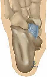 صورة طبية: إعادة بناء الرباط الزنبركي: حل شامل للقدم المسطحة المكتسبة مع الأستاذ الدكتور محمد هطيف