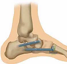 صورة توضيحية لـ إعادة بناء الرباط الزنبركي: حل شامل للقدم المسطحة المكتسبة مع الأستاذ الدكتور محمد هطيف