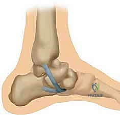 صورة توضيحية لـ إعادة بناء الرباط الزنبركي: حل شامل للقدم المسطحة المكتسبة مع الأستاذ الدكتور محمد هطيف