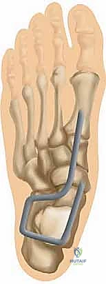 Illustration of spring ligament reconstruction - Dr. Mohammed Hutaif