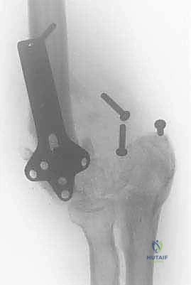 صورة توضيحية لـ إعادة بناء مفصل الكوع المعقد بعد الإصابات: دليلك الشامل مع الأستاذ الدكتور محمد هطيف في صنعاء