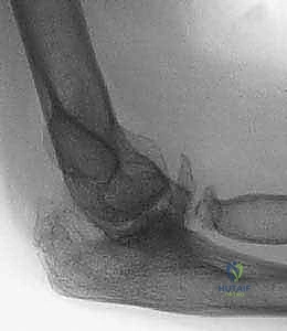 الأربطة والعضلات الداعمة لمفصل الكوع