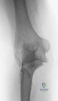 تشريح مفصل الكوع المعقد