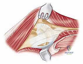 عدم التحام عظام الكوع