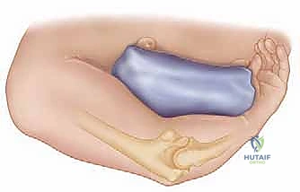 التهاب مفصل الكوع بعد الصدمة