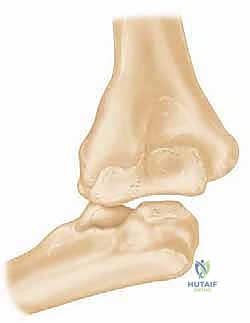خيارات العلاج الجراحي للكوع