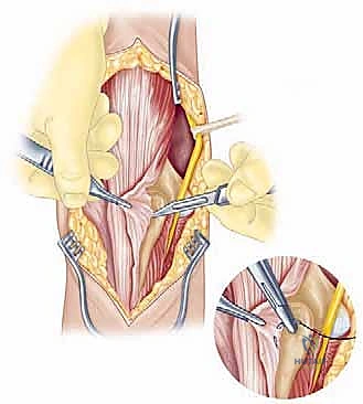 التشخيص الدقيق لإصابات الكوع