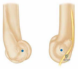 صورة توضيحية لـ إعادة بناء مفصل الكوع المعقد بعد الإصابات: دليلك الشامل مع الأستاذ الدكتور محمد هطيف في صنعاء