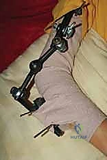 صورة توضيحية لـ إعادة بناء مفصل الكوع المعقد بعد الإصابات: دليلك الشامل مع الأستاذ الدكتور محمد هطيف في صنعاء