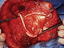 صورة طبية: إعادة بناء مفصل الكوع المعقد بعد الإصابات: دليلك الشامل مع الأستاذ الدكتور محمد هطيف في صنعاء