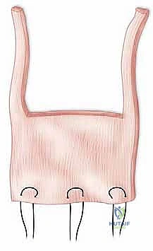 صورة طبية: إعادة بناء مفصل الكوع المعقد بعد الإصابات: دليلك الشامل مع الأستاذ الدكتور محمد هطيف في صنعاء