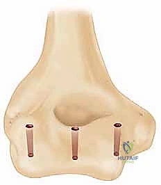 صورة توضيحية لـ إعادة بناء مفصل الكوع المعقد بعد الإصابات: دليلك الشامل مع الأستاذ الدكتور محمد هطيف في صنعاء