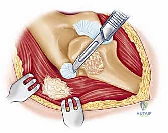 صورة طبية: إعادة بناء مفصل الكوع المعقد بعد الإصابات: دليلك الشامل مع الأستاذ الدكتور محمد هطيف في صنعاء