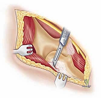 صورة توضيحية لـ إعادة بناء مفصل الكوع المعقد بعد الإصابات: دليلك الشامل مع الأستاذ الدكتور محمد هطيف في صنعاء