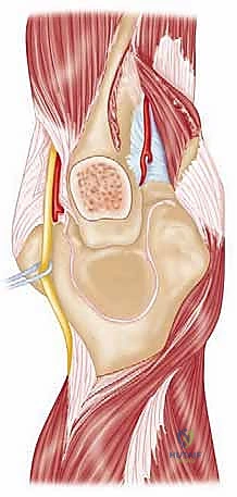 صورة توضيحية لـ إعادة بناء مفصل الكوع المعقد بعد الإصابات: دليلك الشامل مع الأستاذ الدكتور محمد هطيف في صنعاء