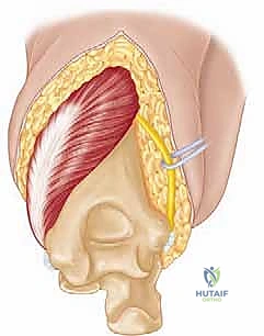 إعادة بناء مفصل الكوع المعقد بعد الإصابات: دليلك الشامل مع الأستاذ الدكتور محمد هطيف في صنعاء
