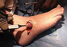 صورة توضح علامة آكل النمل في الأشعة السينية