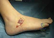 صورة توضح التغيرات الميكانيكية بسبب الالتحام