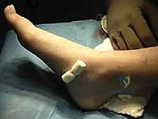 صورة توضيحية لـ علاج التحام العظم الزورقي الكاحلي عند البالغين: حلول الأستاذ الدكتور محمد هطيف في صنعاء