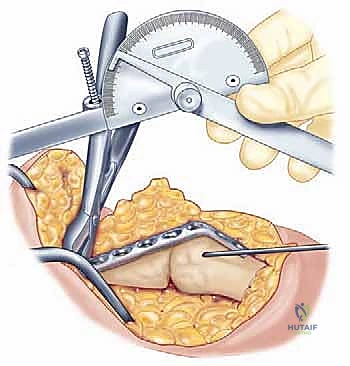 صورة توضيحية لـ تثبيت مفصل الكوع: حل نهائي لآلام المرفق الشديدة واستعادة الوظيفة مع الأستاذ الدكتور محمد هطيف