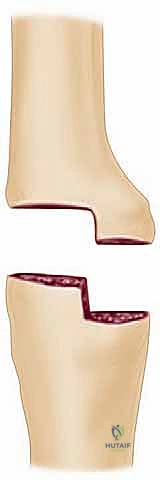 صورة توضيحية لـ تثبيت مفصل الكوع: حل نهائي لآلام المرفق الشديدة واستعادة الوظيفة مع الأستاذ الدكتور محمد هطيف