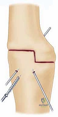 صورة توضيحية لـ تثبيت مفصل الكوع: حل نهائي لآلام المرفق الشديدة واستعادة الوظيفة مع الأستاذ الدكتور محمد هطيف