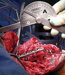 صورة توضيحية لـ تثبيت مفصل الكوع: حل نهائي لآلام المرفق الشديدة واستعادة الوظيفة مع الأستاذ الدكتور محمد هطيف