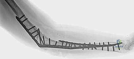 تثبيت مفصل الكوع: حل نهائي لآلام المرفق الشديدة واستعادة الوظيفة مع الأستاذ الدكتور محمد هطيف