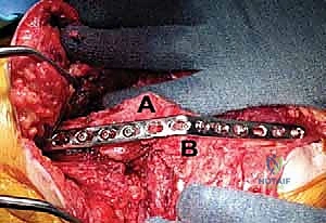 صورة توضيحية لـ تثبيت مفصل الكوع: حل نهائي لآلام المرفق الشديدة واستعادة الوظيفة مع الأستاذ الدكتور محمد هطيف