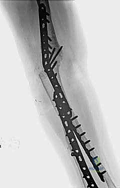صورة توضيحية لـ تثبيت مفصل الكوع: حل نهائي لآلام المرفق الشديدة واستعادة الوظيفة مع الأستاذ الدكتور محمد هطيف