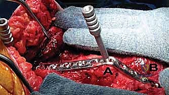 صورة توضيحية لـ تثبيت مفصل الكوع: حل نهائي لآلام المرفق الشديدة واستعادة الوظيفة مع الأستاذ الدكتور محمد هطيف