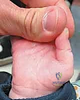 تحديد الأعصاب الرقمية وحمايتها أثناء الجراحة