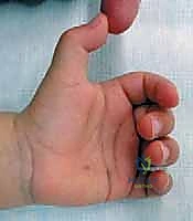 تشريح وتر العضلة القابضة الطويلة للإبهام والبكرة