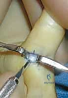 عزل وتحرير البكرة A1 جراحياً