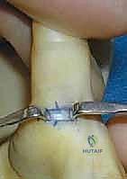 عمل الشق الجراحي الدقيق في قاعدة الإبهام