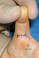 الخيارات العلاجية وتخطيط الجراحة