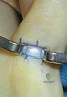 إصبع الإبهام الزنادي عند الأطفال: دليل شامل للآباء والعلاج الفعال في صنعاء مع الأستاذ الدكتور محمد هطيف