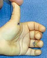Pediatric Trigger Thumb: An Intraoperative Masterclass on A1 Pulley Release